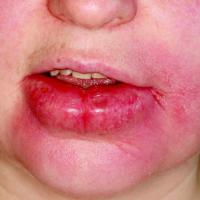 
	Orofacial granulomatosis