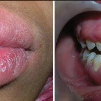 
	Orofacial granulomatosis