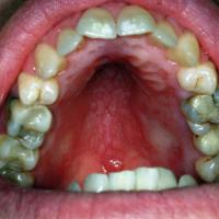
	Orofacial granulomatosis

	Cobblestone…