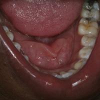 
	Orofacial granulomatosis

	Granulomatous…