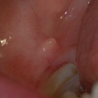 
	Orofacial granulomatosis

	Mucosal tag