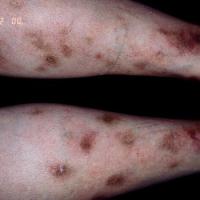 
	Nodular vasculitis (erythema induratum)&nbsp;…