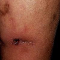 
	Nodular vasculitis (erythema induratum)…