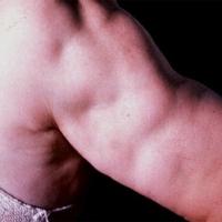 
	Lipoatrophic panniculitis

	The inflammation…
