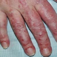 Paraneoplastic Leg Rash Paraneoplastic dermatoses