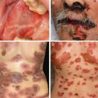 
	Paraneoplastic pemphigus