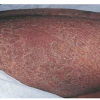
	Acquired ichthyosis secondary to Hodgkin's…