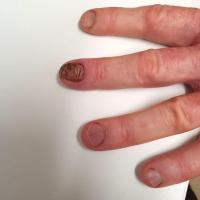 Chronic paronychia
Copied with kind permission…