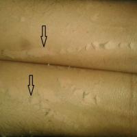 
	Peeling Skin syndrome - type A…