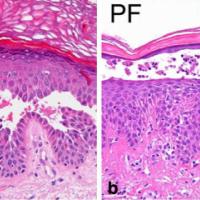 
	Pemphigus foliaceus - histopathology

	Typical…