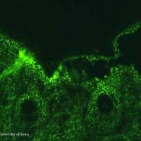 
	Pemphigus foliaceus - direct…