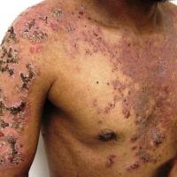 
	Pemphigus foliaceus
