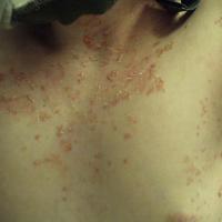 
	Pemphigus foliaceus