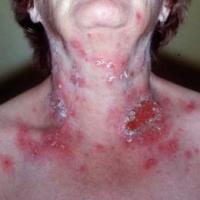
	Pemphigus foliaceus