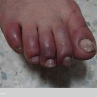 
	Chilblains