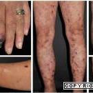 
	Cryoglobulinaemic vasculitis