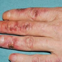 
	Chilblains - ulceration

	Copied with kind…