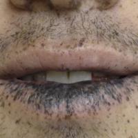 
	Peutz&ndash;Jeghers syndrome