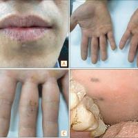 
	Peutz&ndash;Jeghers syndrome