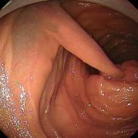 
	Peutz&ndash;Jeghers syndrome - jejunal polyp