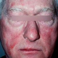 
	Drug-induced photodermatosis&nbsp;

	Note the…