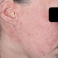 Actinic prurigo&nbsp;