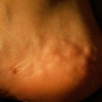 
	Piezogenic pedal papules