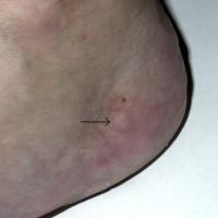 
	Piezogenic pedal papules