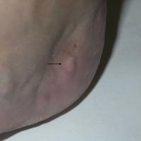 
	Piezogenic pedal papules

	Same patient as…