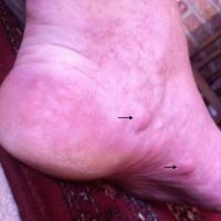 
	Piezogenic pedal papules