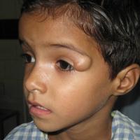 
	Dermoid cyst

	These are most commonly found on…