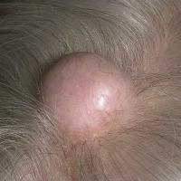 
	Pilar cyst