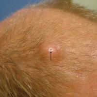 
	An epidermoid cyst (often incorrectly called a…