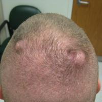 Pilar cysts