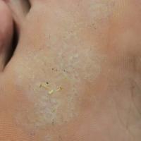 
	Pitted keratolysis