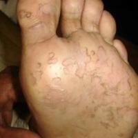 
	Pitted keratolysis

	Lesions have coalesced to…