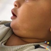 Pityriasis alba&nbsp;
Copied with kind…