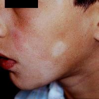 
	Pityriasis alba

	Hypopigmentation more…