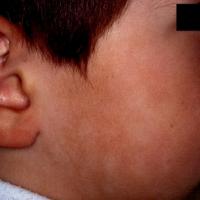 
	Pityriasis alba
	
	The hypopigmentation is…