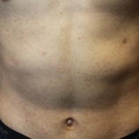 
	PLC on the abdomen