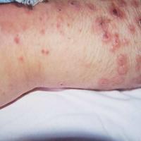
	Febrile papulonecrotic PLEVA