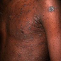 
	Pityriasis rosea with hyperpigmentation in…