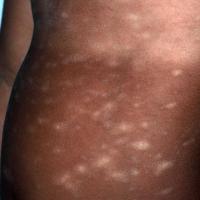 
	Pityriasis rosea with hypopigmentation in skin…