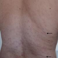 
	Secondary syphilis
	
	Faint red / brown patches…