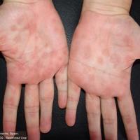 
	Secondary syphilis