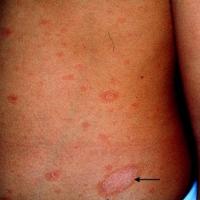 
	Pityriasis rosea

	The herald patch (arrow) has…