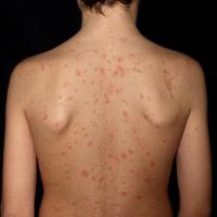 
	Pityriasis rosea

	Lesions on the mid-trunk…