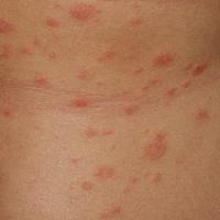 
	Pityriasis rosea