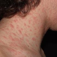
	Pityriasis rosea

	Copied with kind permission…
