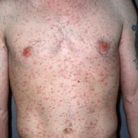 
	Pityriasis rosea

	The differential diagnosis…